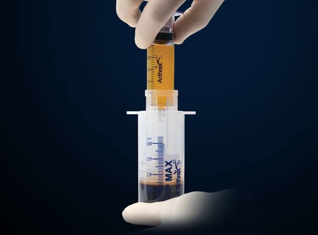 Arthrex ACP MAX preparation syringe containing separated blood components
