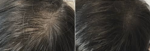 Paired hair and scalp photographs, supplied six-treatment course example 1