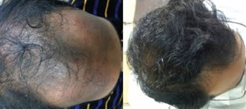 Paired hair and scalp photographs, supplied six-treatment course example 2