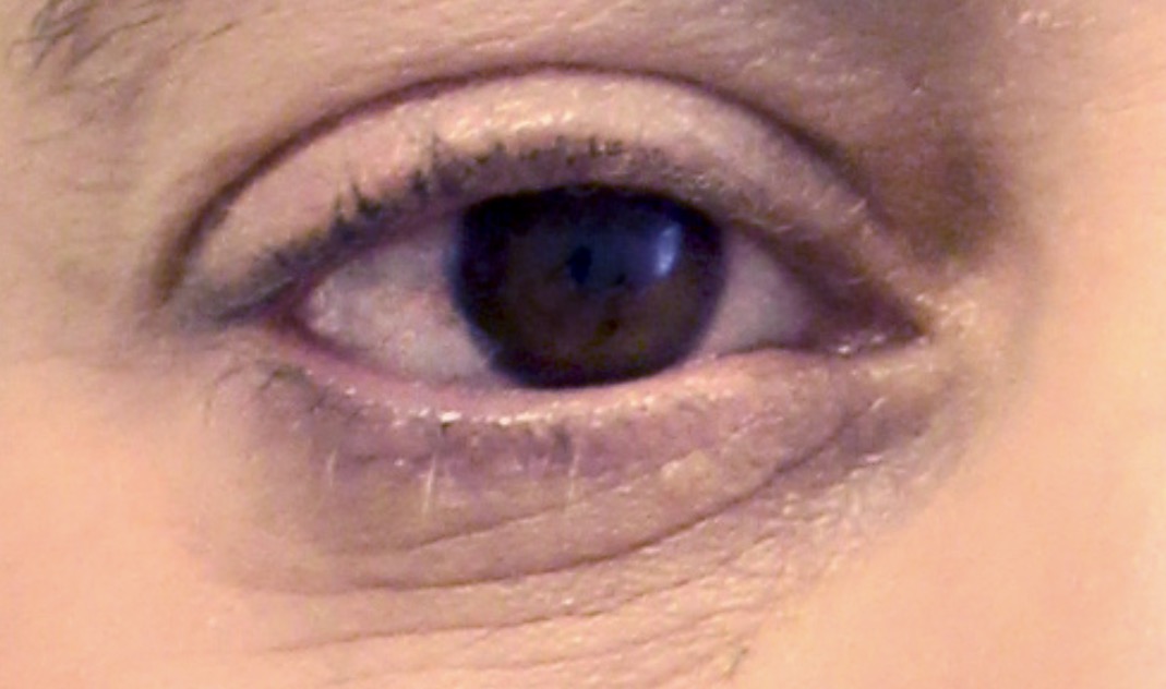 Before the first treatment in the Arthrex ACP brochure sequence