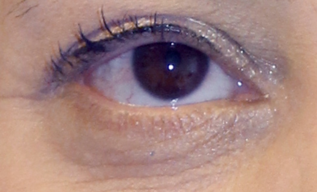 Before the second treatment in the Arthrex ACP brochure sequence