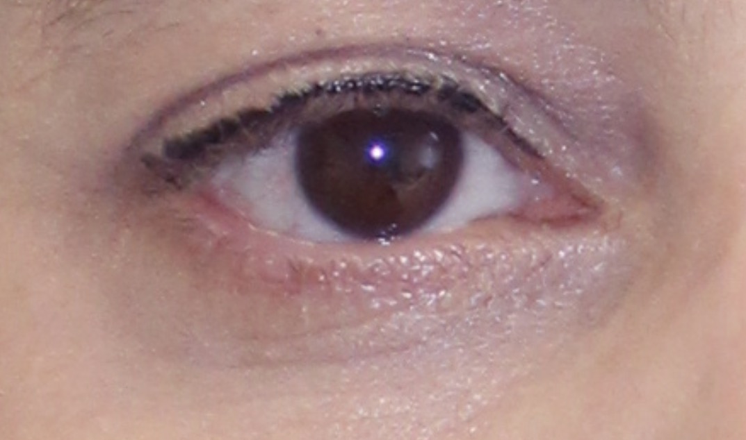 Before the third treatment in the Arthrex ACP brochure sequence