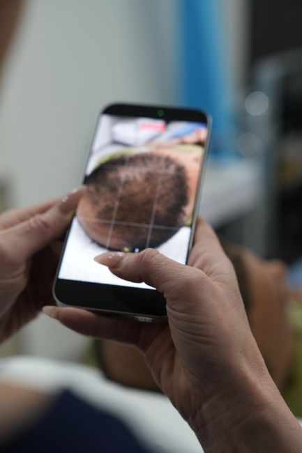 A phone displaying a client’s scalp photograph during a hair consultation
