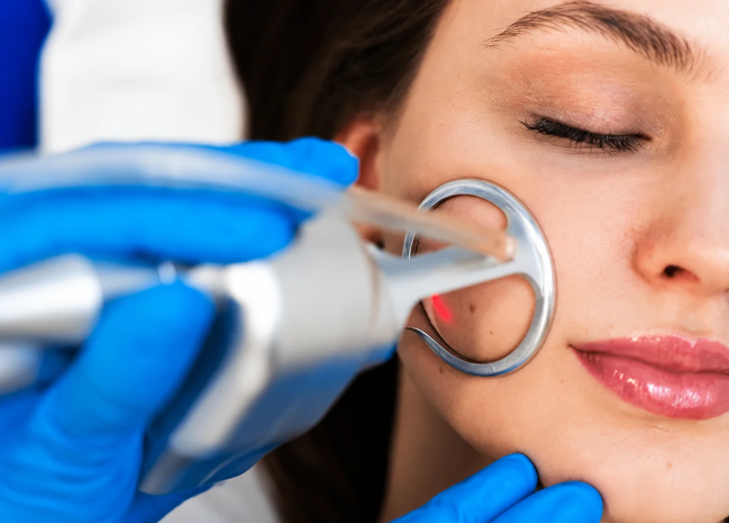 Illustrative facial laser handpiece positioned beside the cheek